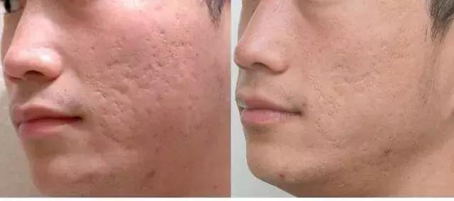 怎么去除脸上的黑痘印红痘印,教你轻松祛除痘印的方法