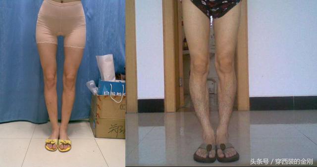 腿型问题怎么改善,o型腿怎样矫正不影响膝关节