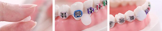 戴牙套扎嘴怎么办,牙套铁丝末端扎嘴怎么办