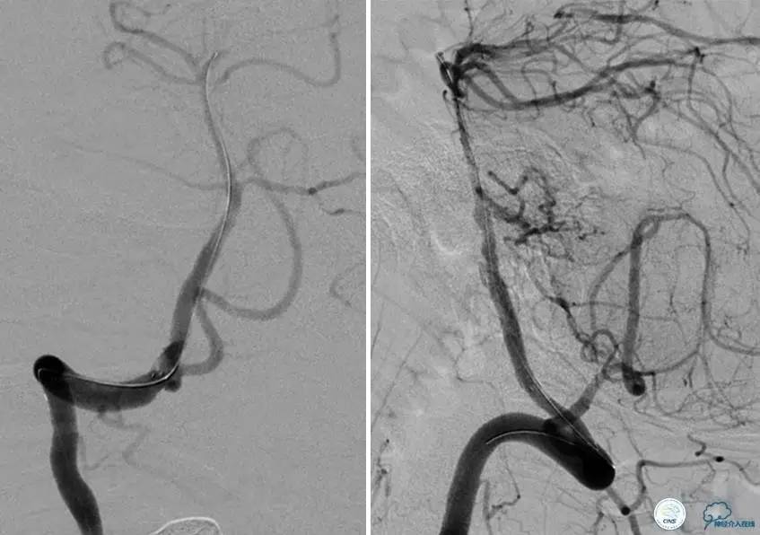 颅内动脉狭窄介入治疗研究,颅内血管cta副作用