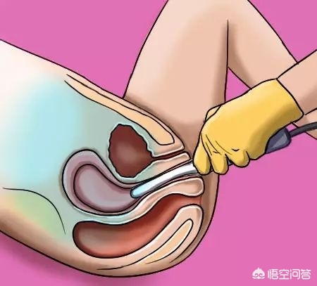 b超能替代脐血流检测吗,b超可以代替孕检吗