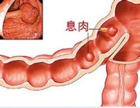 结肠息肉内镜下切除,结肠息肉内镜下切除注意护理