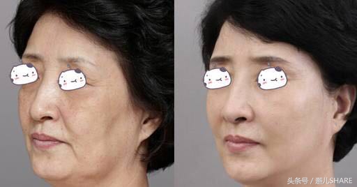 一次超声刀=1000张面膜，你敢说不好吗？