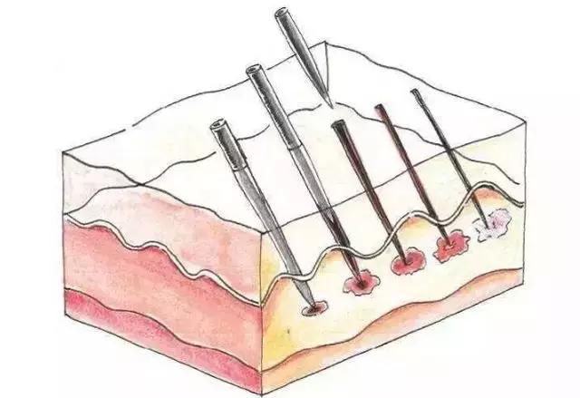 桃树褐斑穿孔病治疗方法,褐斑可以激光治疗吗