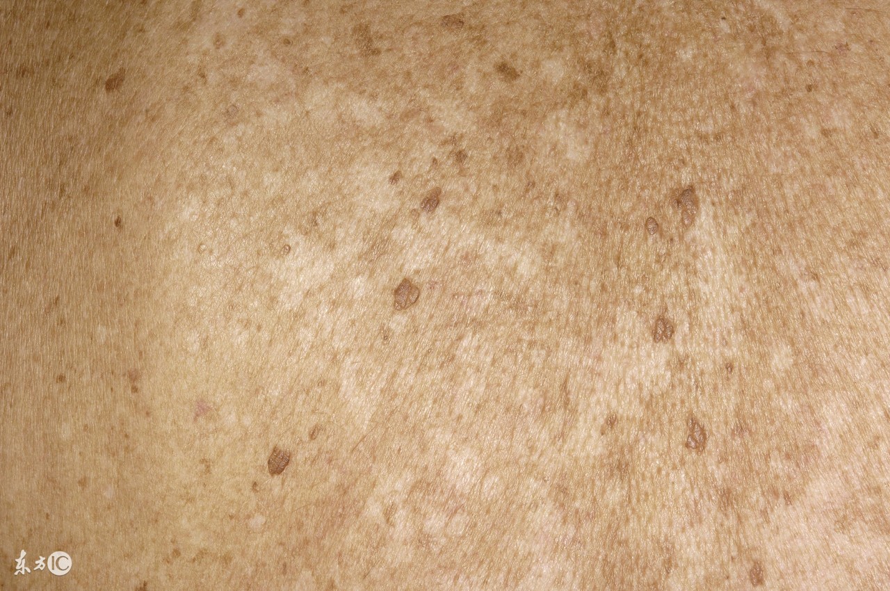 要治好花斑癣需要患者怎么做