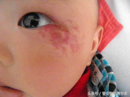 院长分析怎样去除血管瘤！