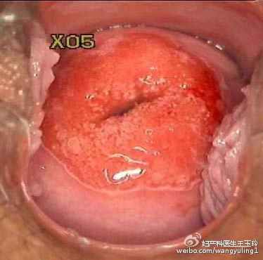 治疗“宫颈糜烂”,这个药被滥用了很多年