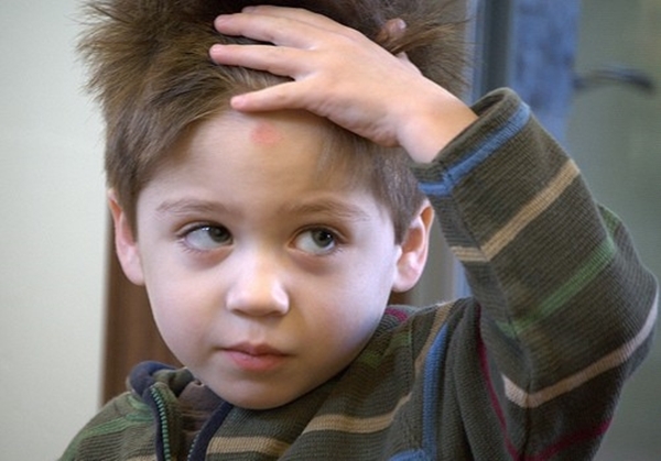 脑袋摔了个大包可以跑步吗,跑步磕到后脑勺一个包