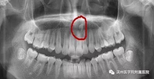 孩子牙缝很小需要干预吗,小朋友牙缝大可以干预吗