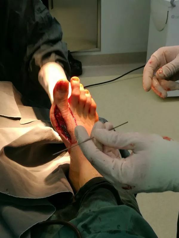 超声引导隐神经阻滞视频教学,超声引导下腰椎旁神经阻滞视频