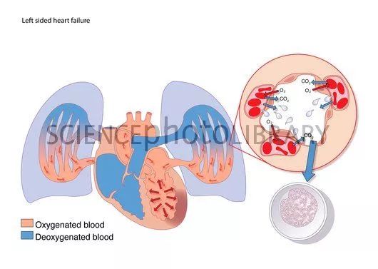 射血分数低于多少为心力衰竭,心力衰竭射血值19