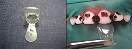 乳前牙预成冠补牙过程,乳前牙龋坏修复