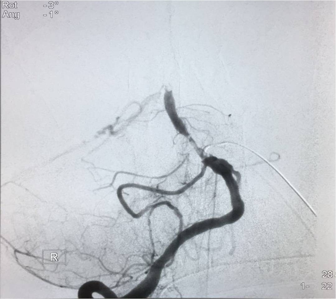 取栓慢性闭塞如何避免血栓逃逸,急性大脑中动脉栓塞取栓时间