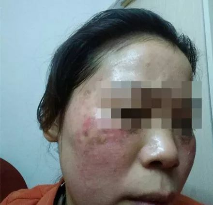 常州这种地方整容不失败才怪！2名女子为变美，一个差点眼瞎一个脸变猪头！