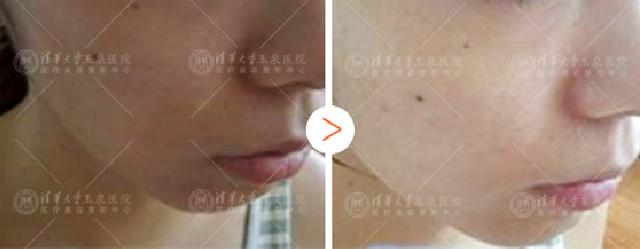 干皮用什么护肤品不容易脱妆,皮肤干燥容易过敏用什么粉底液