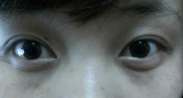 黑眼圈眼纹眼袋是怎么来的,黑眼圈眼袋眼纹问题