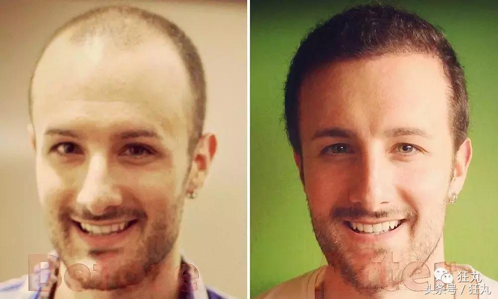 麦当劳薯条治疗脱发,麦当劳薯条掉头发