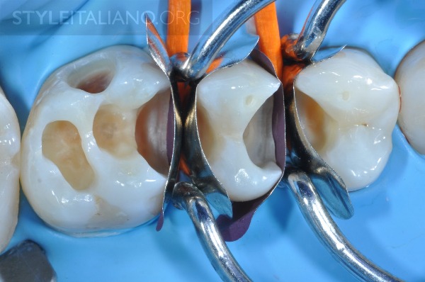 后牙修补贴片,后牙全瓷修复图片