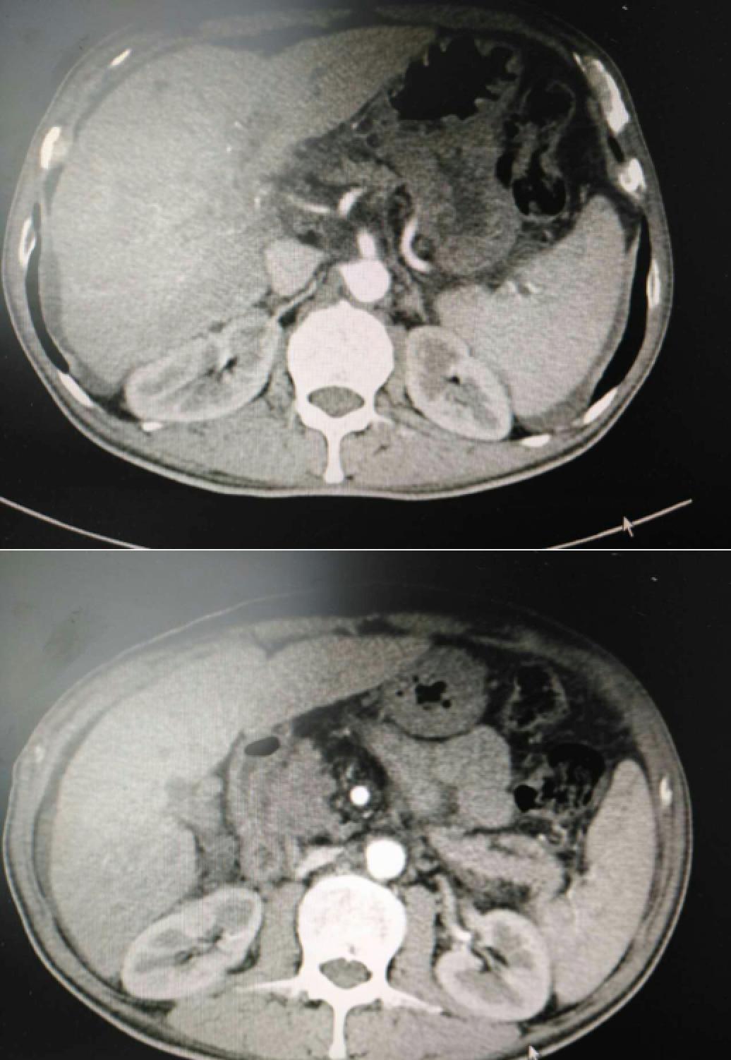 周仲国评价肝癌病例,周仲国分享肝癌早期复发