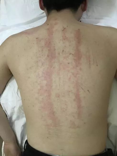 阿娇刮痧后背效果,阿娇背部刮痧图片