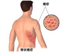 康复疗法,北京国医火针疗法视频
