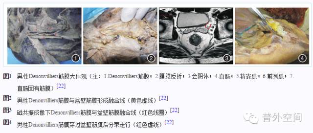 从膜外科角度对Denonvilliers筋膜应用解剖的再认识