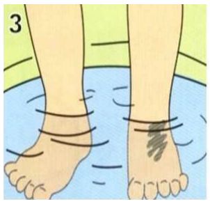 疼！家长们注意：熊孩子这样玩，钢丝刺穿右手中指！