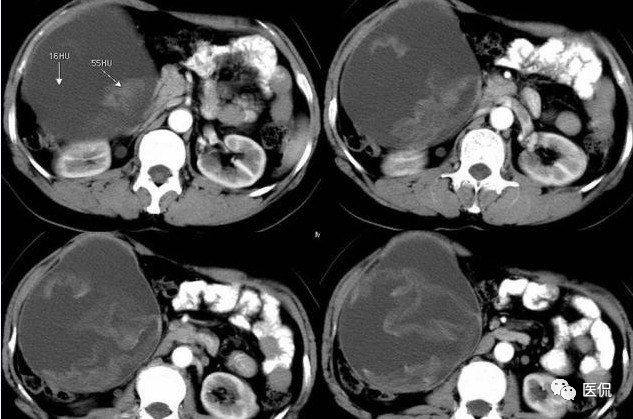 手术纱布遗留在体内可以吸收吗,手术纱布忘了取出会怎样