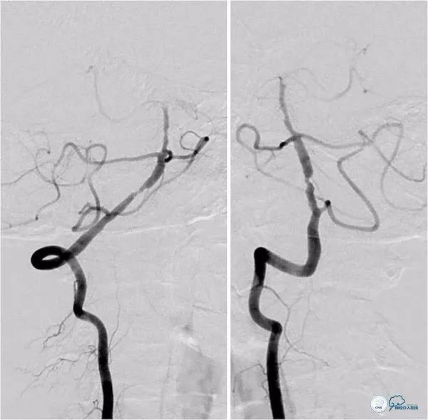 天坛医院做椎动脉狭窄多少要手术,天坛椎动脉狭窄