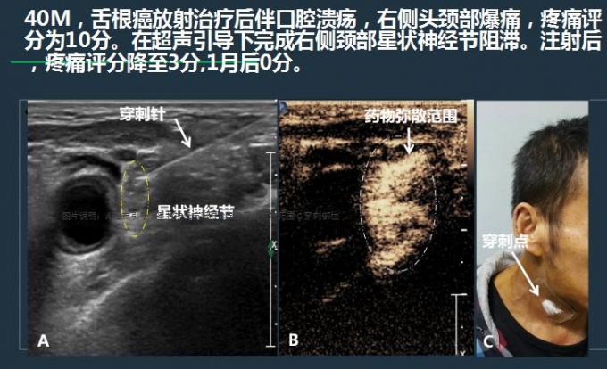 催眠心理疏导治疗成都,催眠治疗可以治疗癌症吗