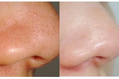 教你正确祛黑头姿势,你一定要知道黑头的克星