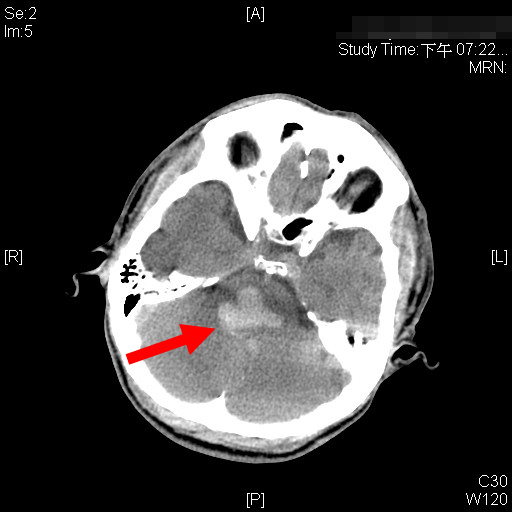 脑干出血面积40%还有救吗,脑干出血器官衰竭还有救吗