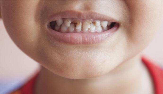 每天刷牙牙齿还是发黄是怎么回事,饮用含氟量过大的水导致牙齿发黄