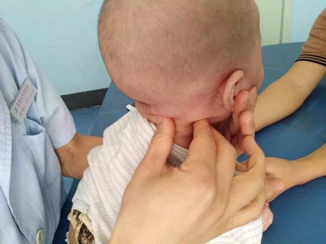 小儿推拿斜颈穴位有哪些,小儿斜颈推拿视频教程