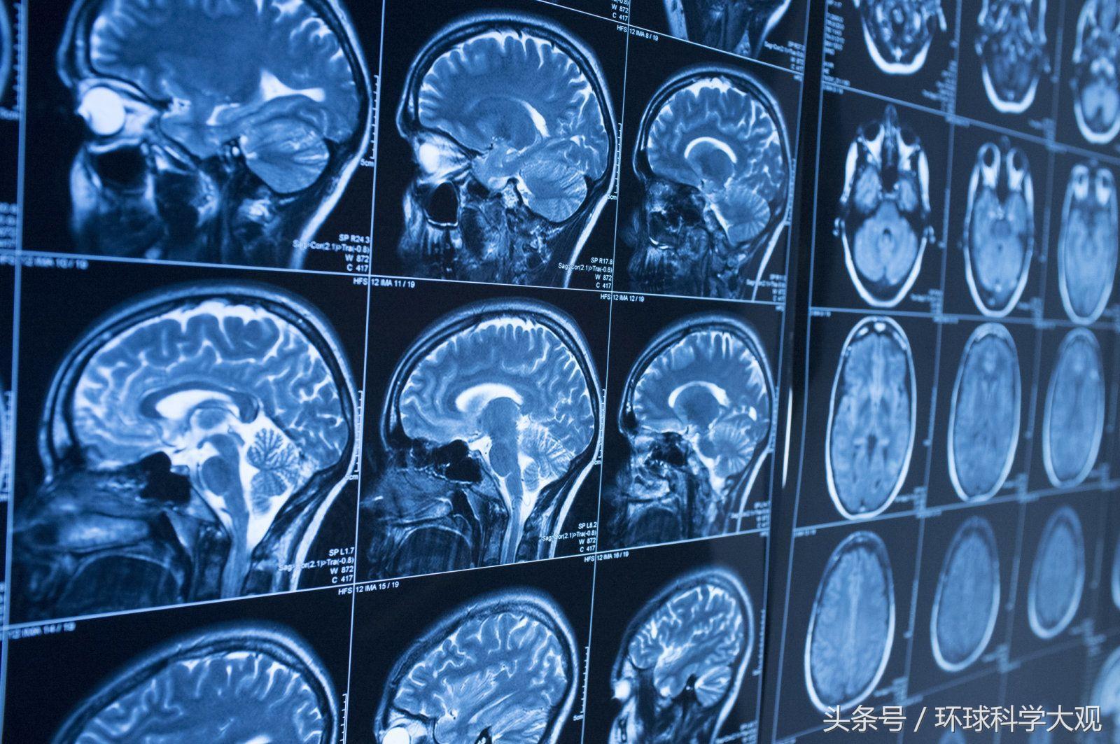 美国预防老年痴呆新药,新突破老年痴呆