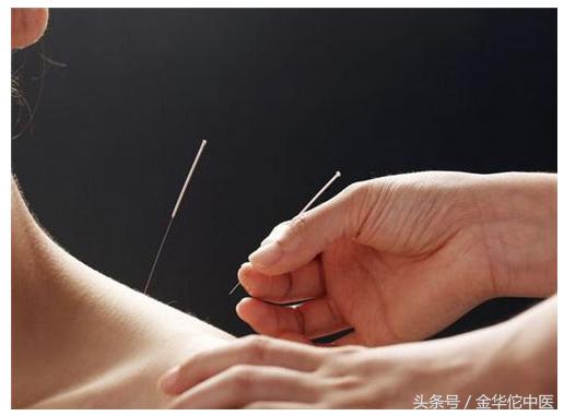 孕妇可不可以针灸,孕期能不能脖子针灸