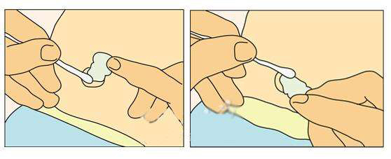 新生儿脐带的护理及异常情况处理,新生儿脐带护理及异常情况处理