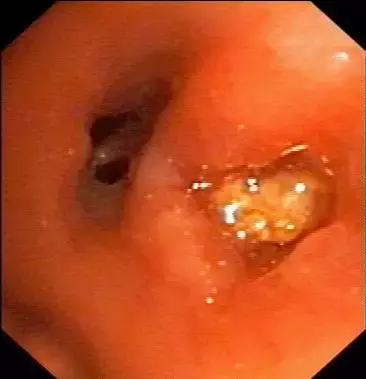 反复咳嗽、支气管炎老不好?当心异物在作祟