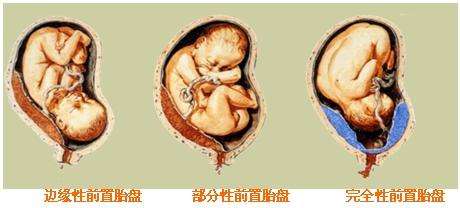 前置胎盘和前壁胎盘22周能查到吗,前壁孕24周胎盘低置是前置胎盘吗