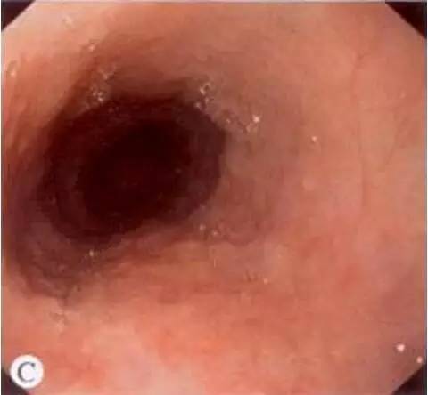 早期食管癌用内镜可以根除吗,超声内镜可以查出早期食管癌吗