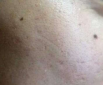 油性皮肤毛孔粗大怎么改善最有效,毛孔出油粗大如何改善小技巧