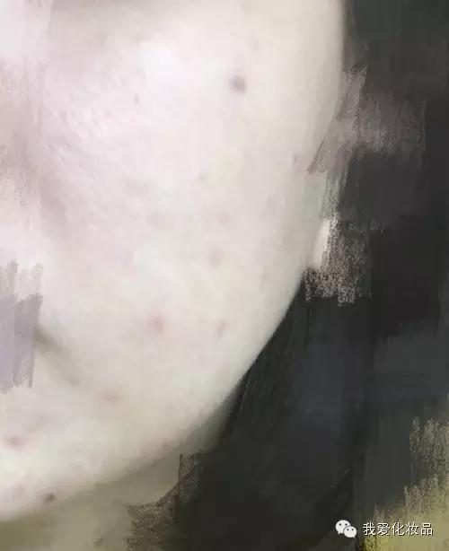 油皮痘肌适合的护肤品牌子,混油皮痘肌适用的护肤品推荐