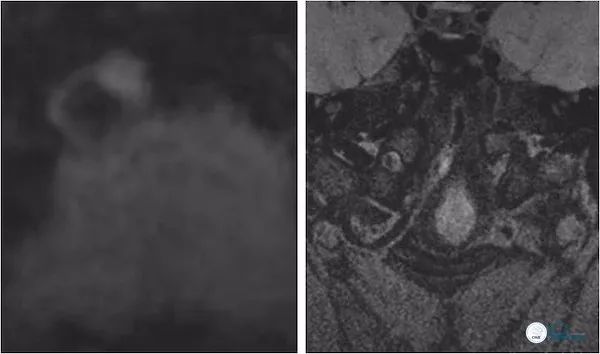 天坛医院做椎动脉狭窄多少要手术,天坛椎动脉狭窄