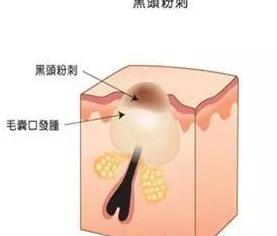 去黑头舒缓压力,教你如何去黑头