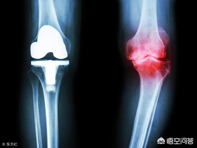 长骨刺会引起哪些状况,长骨刺会有什么症状