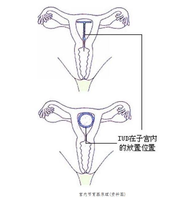 现代女性戴环过程痛苦吗,妇女戴环是啥样的