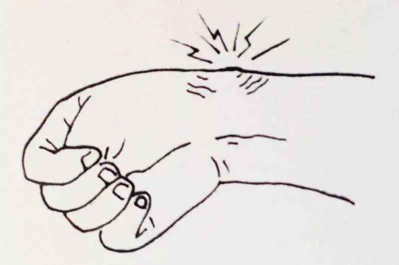 “哪有好医生?”之为什么人人都会得的腱鞘炎,治不好?