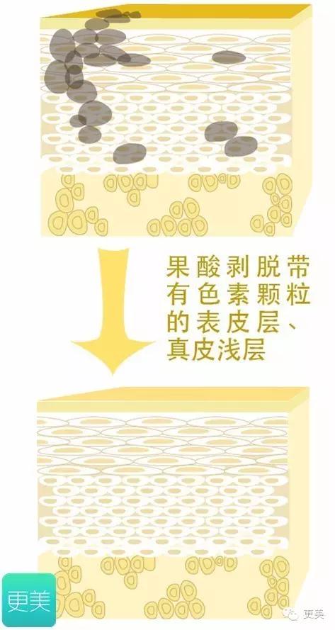 果酸换肤是整容吗,果酸换肤不做后会复发吗