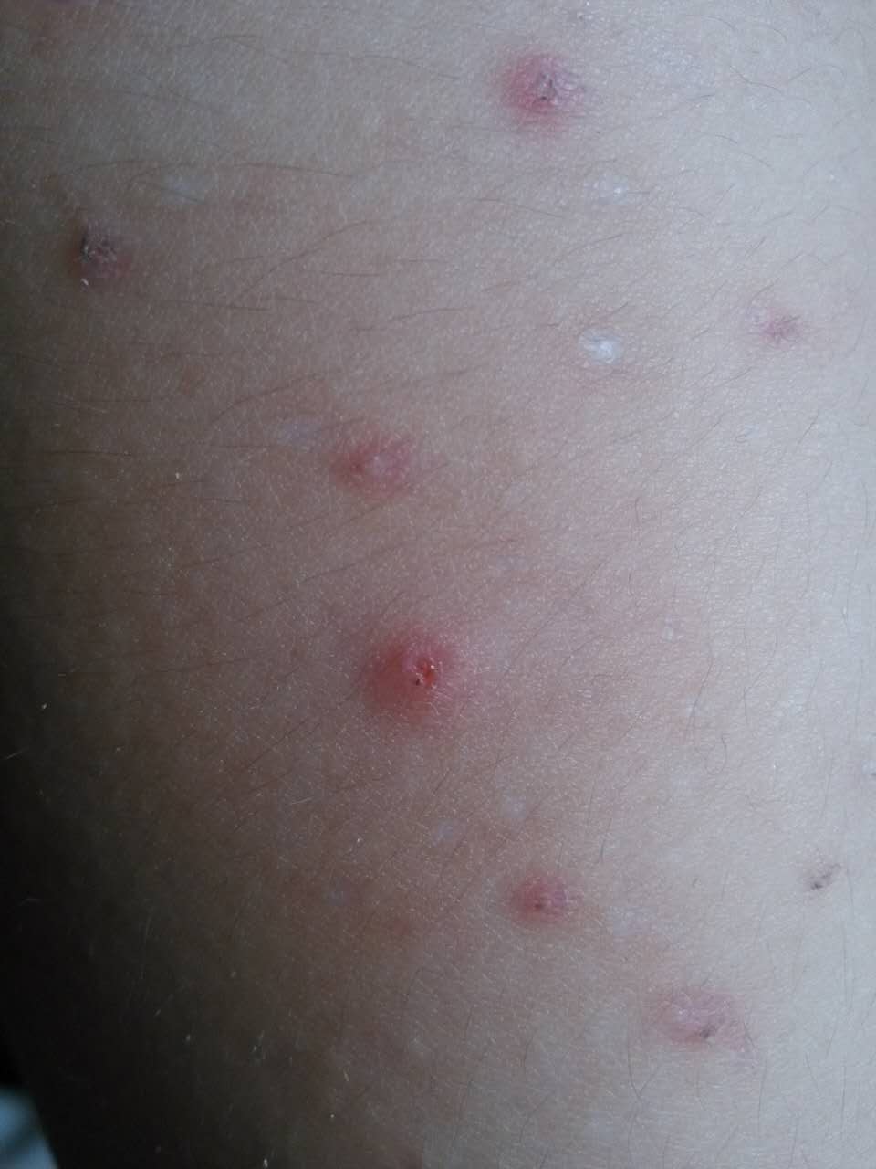 蚊虫咬了有什么办法,蚊虫咬了特别痒怎么办