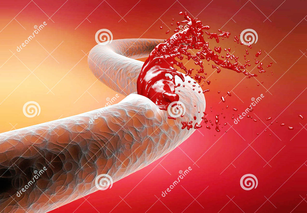 美国治疗主动脉夹层,倪海厦治疗主动脉夹层